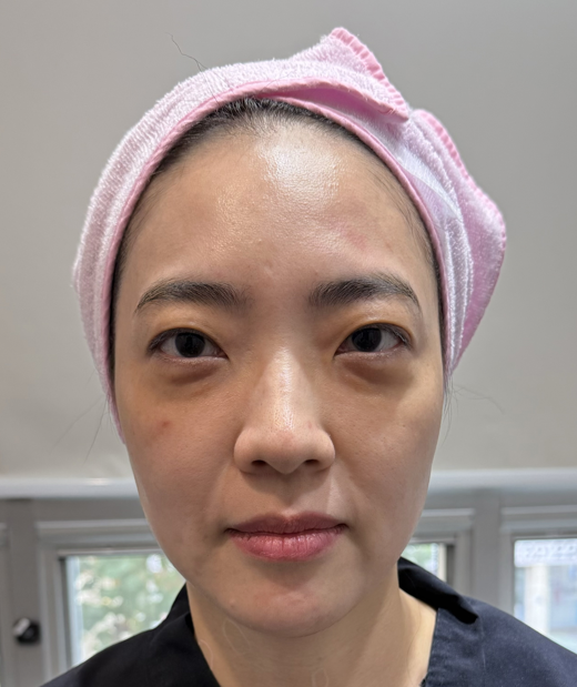 코그실리프팅, 대표원장이 직접 시술받아 봤습니다 관련 이미지 3