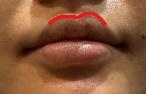 왕십리입술필러? 비대칭 개선한 실제 케이스 보여드립니다 관련 이미지 4