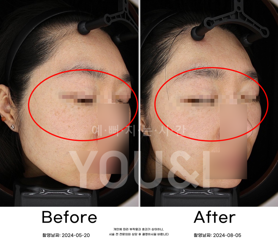 왕십리 잡티제거 레이저로 깨끗하게 <실제 시술 후기> 관련 이미지 5