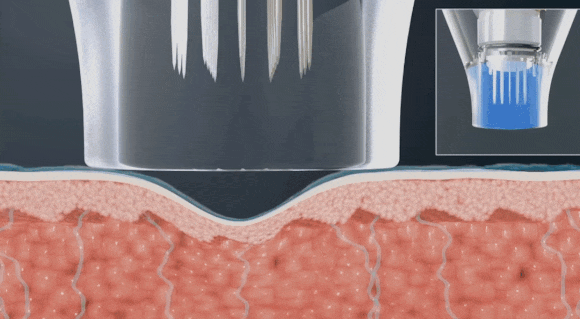 왕십리포텐자? 다재다능한 시술 찾는다면 <필독> 관련 이미지 6