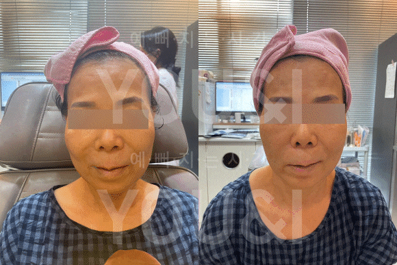 성동구 왕십리 실리프팅 팔자주름 개선 사례 <실제 후기> 관련 이미지 5