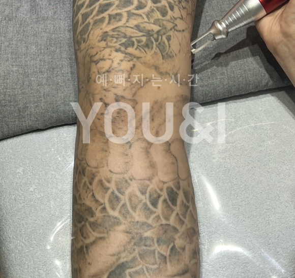 성동구 문신제거 잘하는 곳? 실제 치료 후기 관련 이미지 7