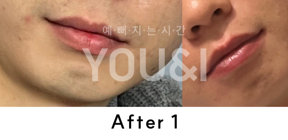 왕십리 레이저제모? 거뭇거뭇한 수염 제거하기 <실제 시술 후기> 관련 이미지 4