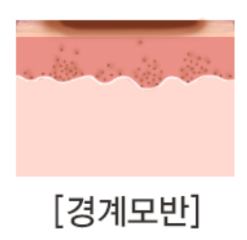 왕십리점제거 피부과 알아보신다면 관련 이미지 3