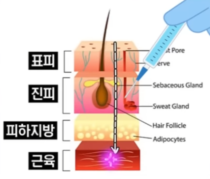 성동구 리쥬란힐러, 정말 만능 스킨부스터일까요? 관련 이미지 4