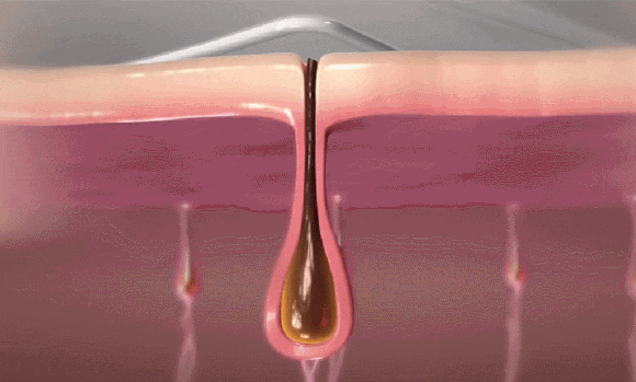 성동구 레이저제모, 제대로 효과 보려면 관련 이미지 4