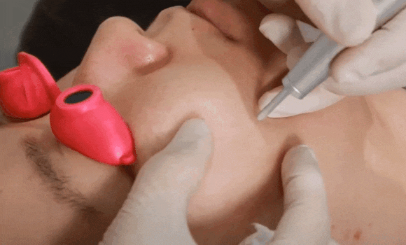 왕십리사마귀? 딱딱한 각질이 못생겨 보인다면 읽어주세요 관련 이미지 5