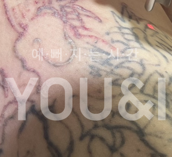 성동구 문신제거 잘하는 곳? 실제 치료 후기 관련 이미지 4