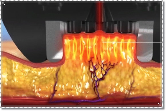 인모드FX포마차이? 피부과 전문의가 알려드립니다 관련 이미지 6
