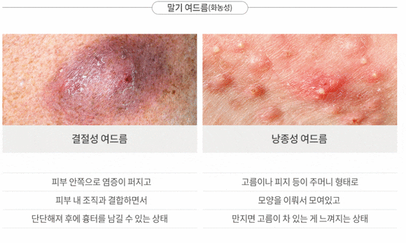 왕십리여드름, 어떻게 해결할 수 있을까요? 관련 이미지 5