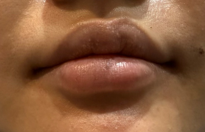 왕십리입술필러? 비대칭 개선한 실제 케이스 보여드립니다 관련 이미지 9