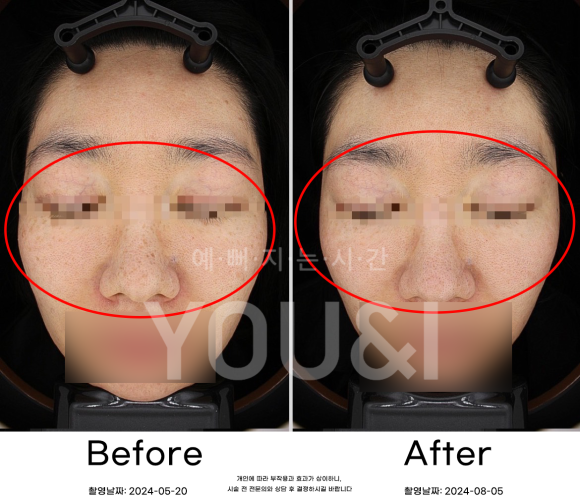 왕십리 잡티제거 레이저로 깨끗하게 <실제 시술 후기> 관련 이미지 2