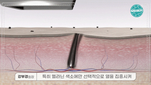 왕십리역레이저제모? 잘 하는 곳의 1가지 특징 관련 이미지 3