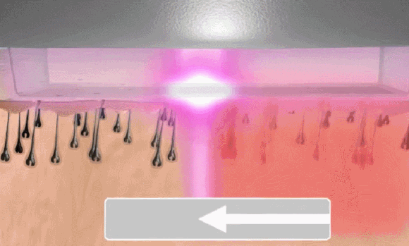 성동구 레이저제모, 제대로 효과 보려면 관련 이미지 2