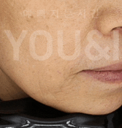 왕십리 리프팅, 올리지오 팔자주름 개선 시술 후기 관련 이미지 5