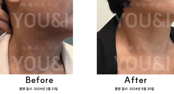 성동구 왕십리 목 릴흑피증(릴흑색증) 실제 치료 사례 관련 이미지 6