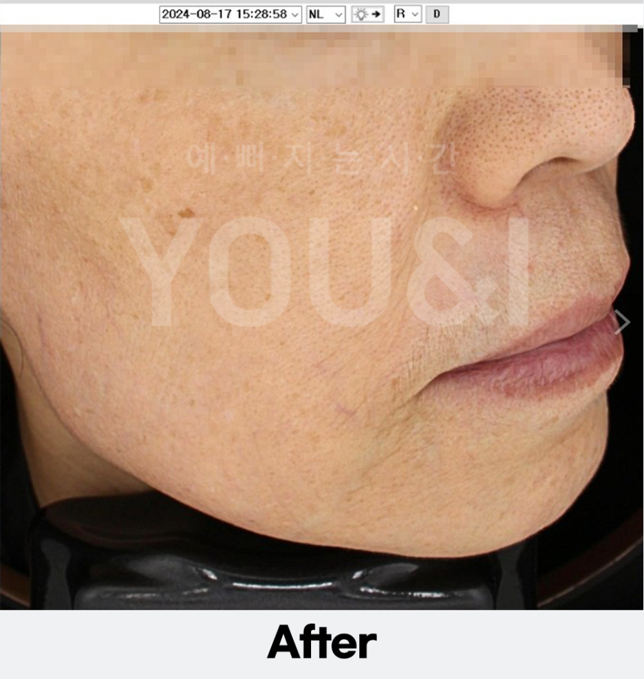 왕십리 리프팅, 올리지오 팔자주름 개선 시술 후기 관련 이미지 3