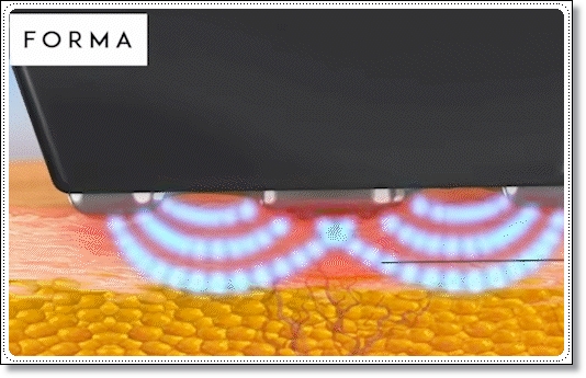 인모드FX포마차이? 피부과 전문의가 알려드립니다 관련 이미지 3