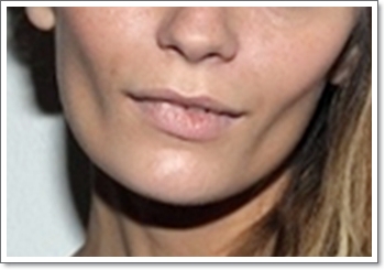 왕십리피부과 탄력 개선 리프팅, 신중해야 하는 이유는? 관련 이미지 8