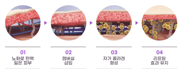 성동구리프팅, 어떤 시술을 받을지 고민이라면? 관련 이미지 4