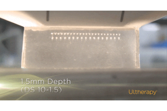 왕십리 슈링크, 울쎄라와 고민된다면 <필독> 관련 이미지 2