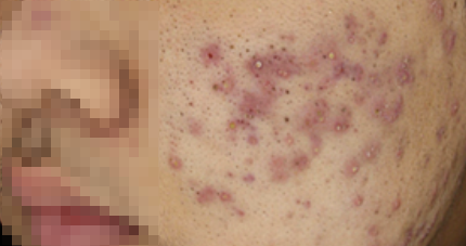 왕십리에토좀, 여드름으로 고민이라면 관련 이미지 7