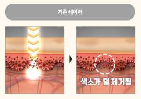 왕십리 기미제거 잡티제거, 효과 못 봤다면 관련 이미지 5