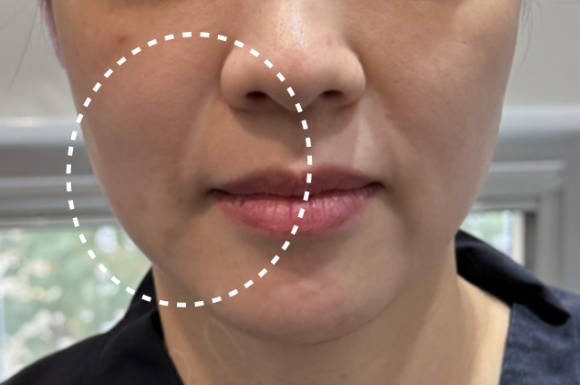 코그실리프팅, 대표원장이 직접 시술받아 봤습니다 관련 이미지 12