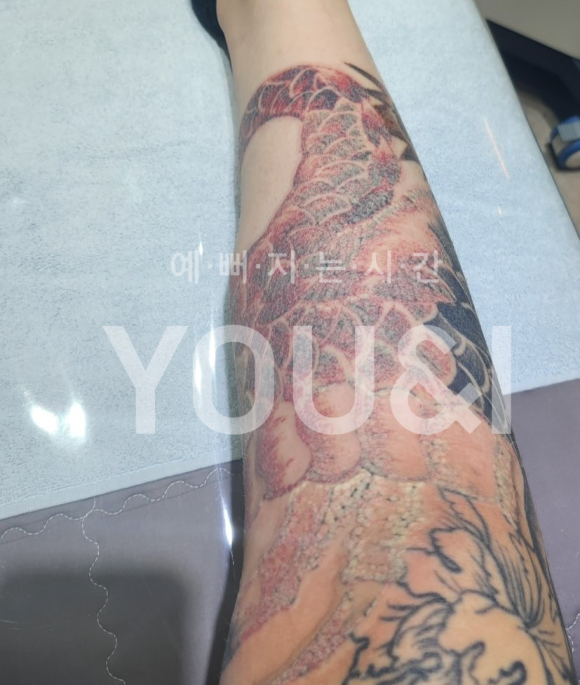 성동구 문신제거 잘하는 곳? 실제 치료 후기 관련 이미지 3