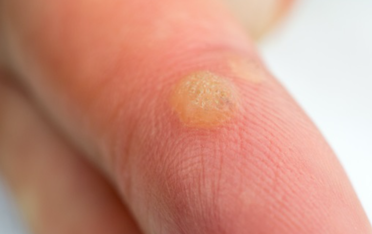 왕십리사마귀? 딱딱한 각질이 못생겨 보인다면 읽어주세요 관련 이미지 3