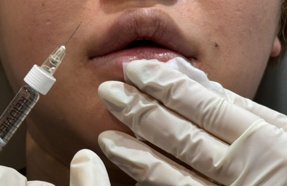 왕십리입술필러? 비대칭 개선한 실제 케이스 보여드립니다 관련 이미지 7