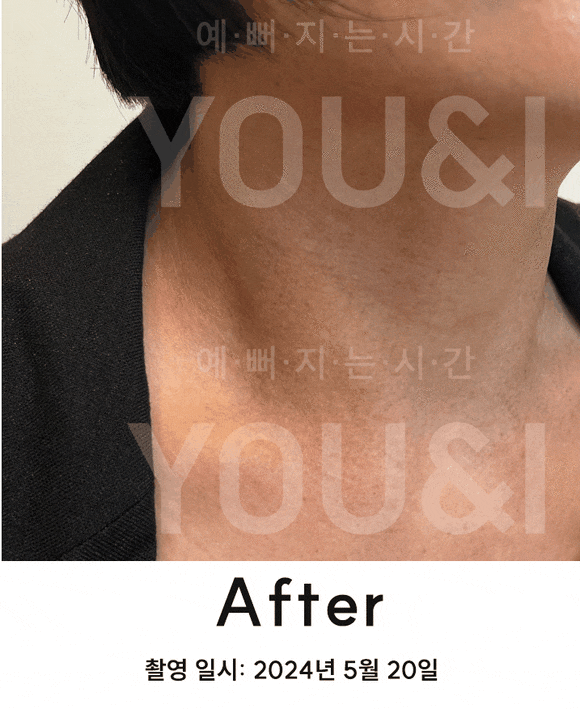 성동구 왕십리 목 릴흑피증(릴흑색증) 실제 치료 사례 관련 이미지 5