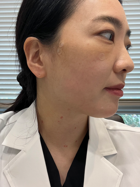 코그실리프팅, 대표원장이 직접 시술받아 봤습니다 관련 이미지 15