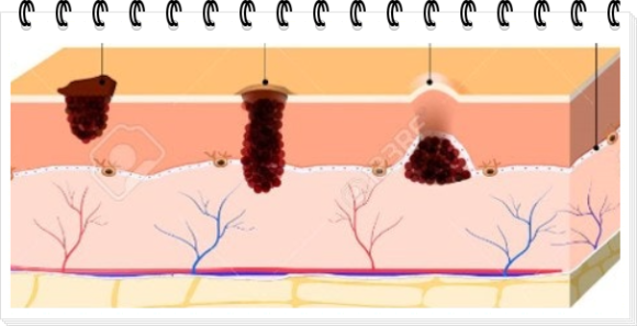 왕십리점빼기, 흉터가 걱정된다면? 관련 이미지 7