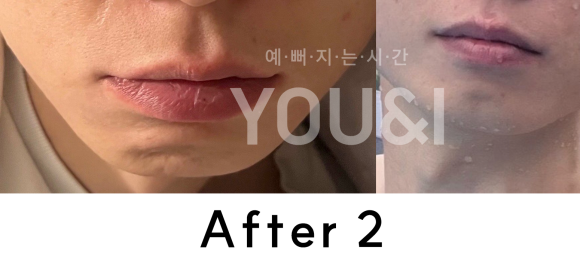 왕십리 레이저제모? 거뭇거뭇한 수염 제거하기 <실제 시술 후기> 관련 이미지 5