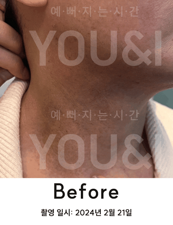 성동구 왕십리 목 릴흑피증(릴흑색증) 실제 치료 사례 관련 이미지 3