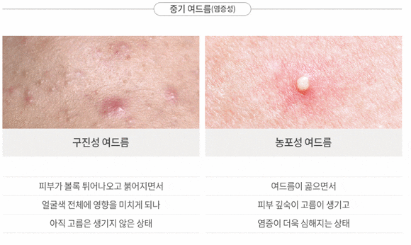 왕십리여드름, 어떻게 해결할 수 있을까요? 관련 이미지 4
