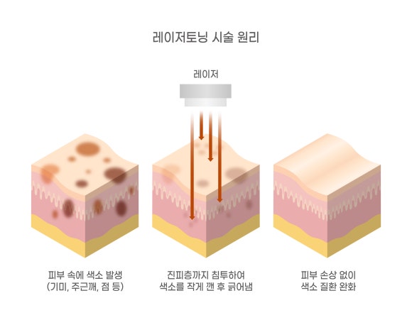 왕십리피코토닝, 기미가 고민이시라면? 관련 이미지 3