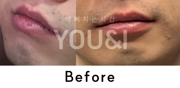 왕십리 레이저제모? 거뭇거뭇한 수염 제거하기 <실제 시술 후기> 관련 이미지 2
