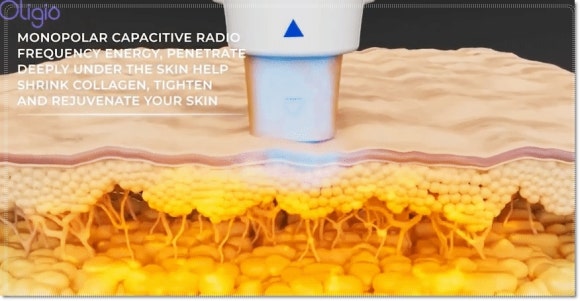 슈링크올리지오차이, 어떤 시술이 적합할지 궁금하다면? 관련 이미지 3