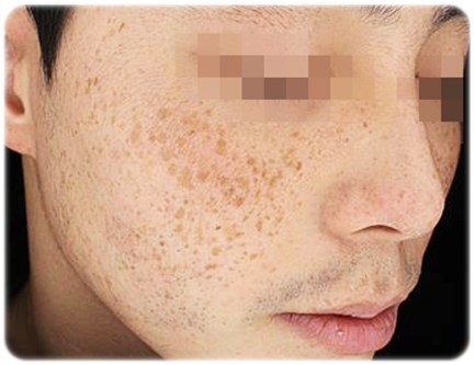 왕십리피부과 시술 추천받아도 신중하게 결정하세요 관련 이미지 4