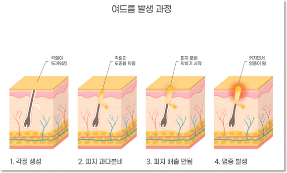 왕십리여드름압출, 치료하지 않아도 되는 여드름? 관련 이미지 3