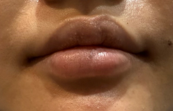 왕십리입술필러? 비대칭 개선한 실제 케이스 보여드립니다 관련 이미지 3