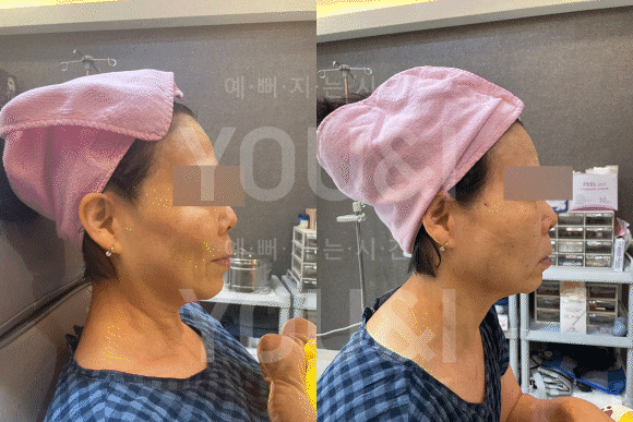 성동구 왕십리 실리프팅 팔자주름 개선 사례 <실제 후기> 관련 이미지 3