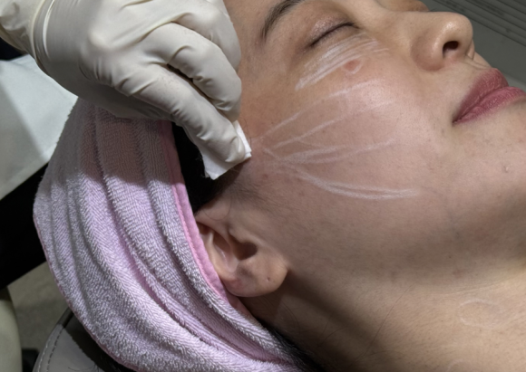 코그실리프팅, 대표원장이 직접 시술받아 봤습니다 관련 이미지 7