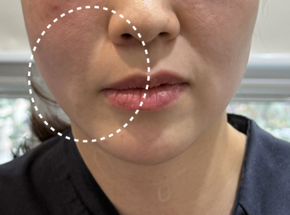 코그실리프팅, 대표원장이 직접 시술받아 봤습니다 관련 이미지 13