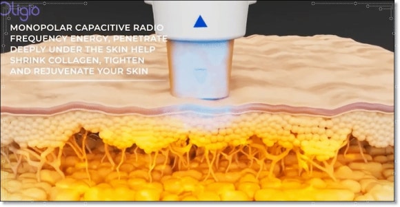 인모드FX포마차이? 피부과 전문의가 알려드립니다 관련 이미지 4