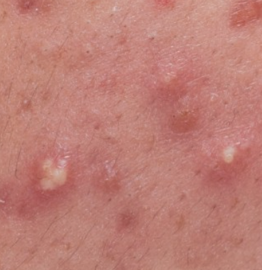 왕십리에토좀, 여드름으로 고민이라면 관련 이미지 6