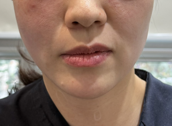 코그실리프팅, 대표원장이 직접 시술받아 봤습니다 관련 이미지 10