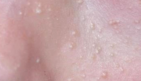 왕십리비립종, 눈가 주변에 돌기가 생겼다면? 관련 이미지 3